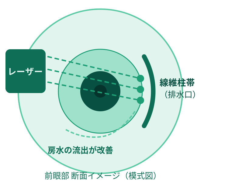 SLTレーザー治療のイメージ